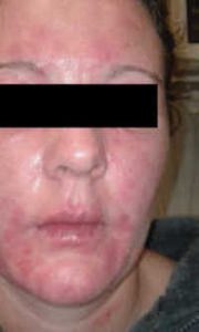 Eczema treatment 40 year old female. What are Probiotics?