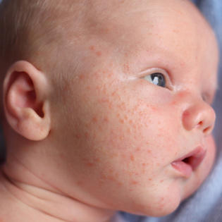 Infant-Acne-baby-skin-disorders