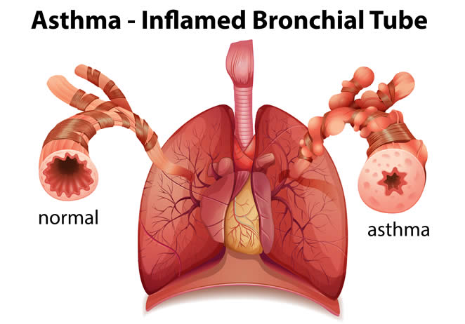 asthma inflamed tube