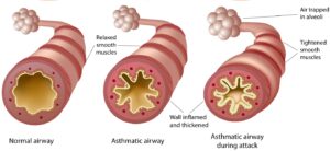 asthmatic-airway-Shutterstock