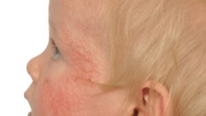 child with eczema 2