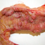 crohns-disease4