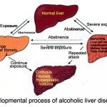 Alcoholic Liver Process