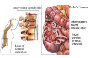 Ankylosing Spondylitis and Crohns Disease often occur together