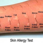 skin-testing-allergies