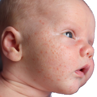 Eczema treatments, the good, the bad and the ugly