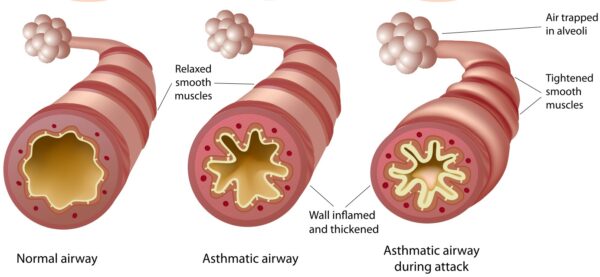 Asthma History Noster ProBiotics