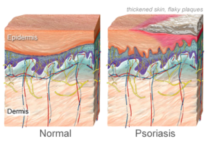 Psoriasis, the history