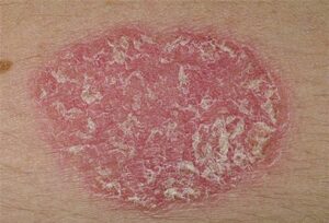 Psoriasis treatments, the good, the bad and the ugly