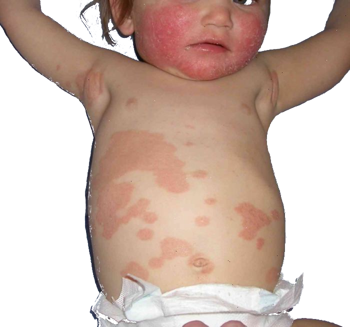 Psoriasis safe and effective long term treatment