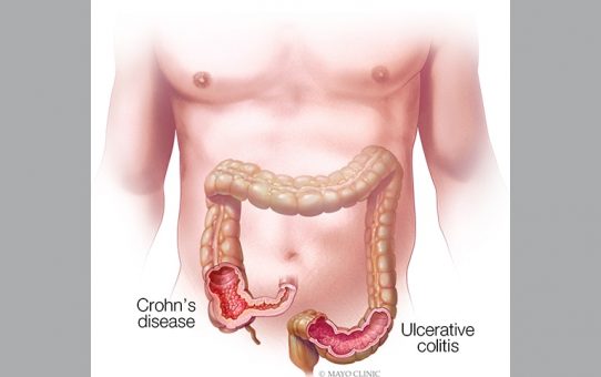 Ulcerative Colitis - What is it?