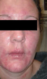 The Results of Eczema Treatment for a 40-Year-Old Female