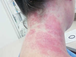 A 71-year-old female came with complaint of itching and eczema