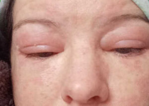 Eczema treatment 40 year old female
